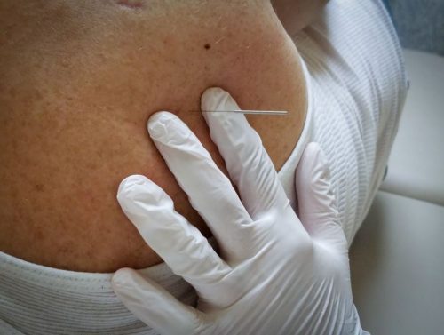 Dry Needling at Valley Regional Hospital in Claremont NH